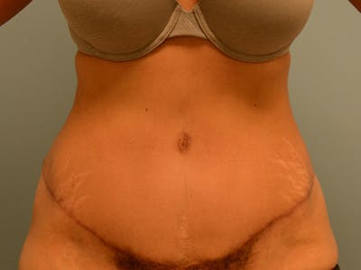 腹部整形手术前后图库-患者120905372 -图2
