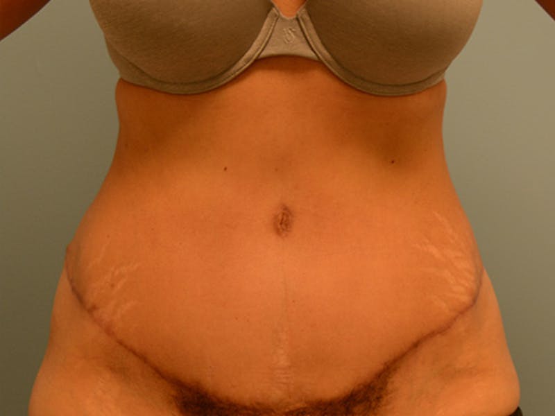 Tummy Tuck Before & After Gallery - Patient 120905372 - Image 2