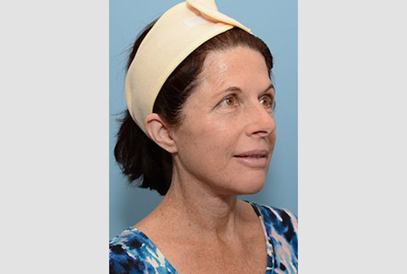 Facelift Before & After Gallery - Patient 120905373 - Image 4