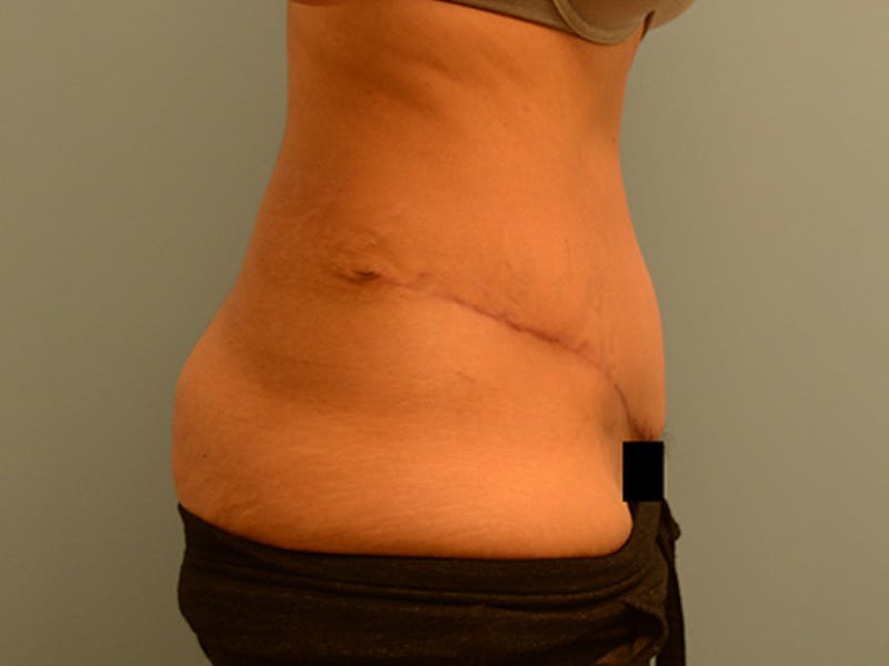 Tummy Tuck Before & After Gallery - Patient 120905372 - Image 4