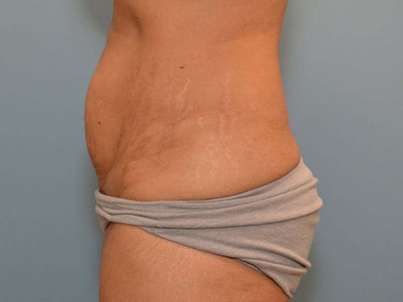 Tummy Tuck Before & After Gallery - Patient 120905372 - Image 5
