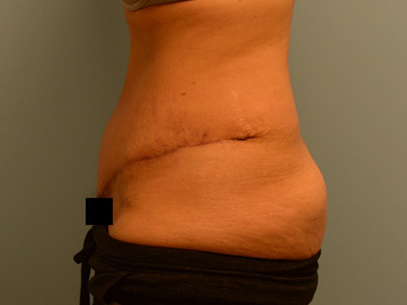 Tummy Tuck Before & After Gallery - Patient 120905372 - Image 6