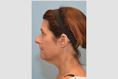 Neck Lift Before & After Gallery - Patient 343727 - Image 1