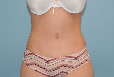 Tummy Tuck Before & After Gallery - Patient 120905374 - Image 2