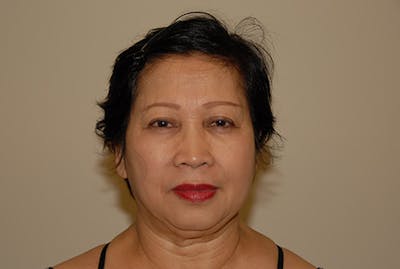 Facelift Before & After Gallery - Patient 120905375 - Image 1