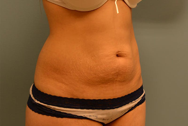 Tummy Tuck Before & After Gallery - Patient 120905374 - Image 3