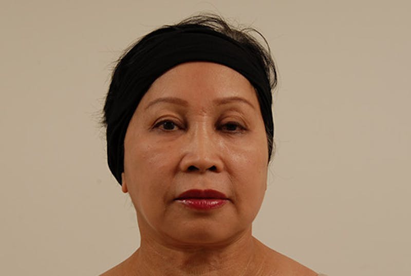 Facelift Before & After Gallery - Patient 120905375 - Image 2