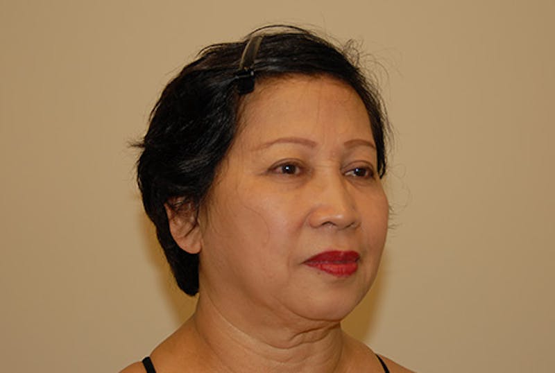 Facelift Before & After Gallery - Patient 120905375 - Image 3