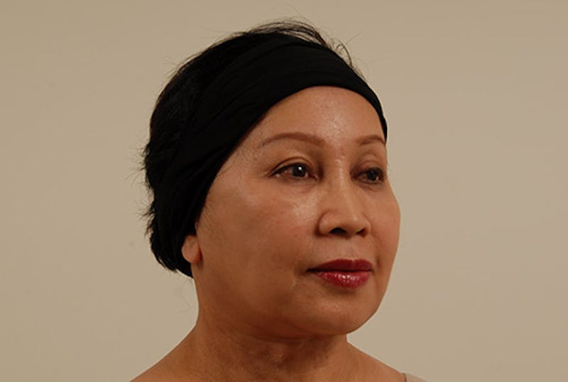 Facelift Before & After Gallery - Patient 120905375 - Image 4