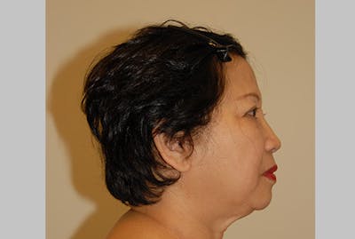 Neck Lift Before & After Gallery - Patient 342106 - Image 1