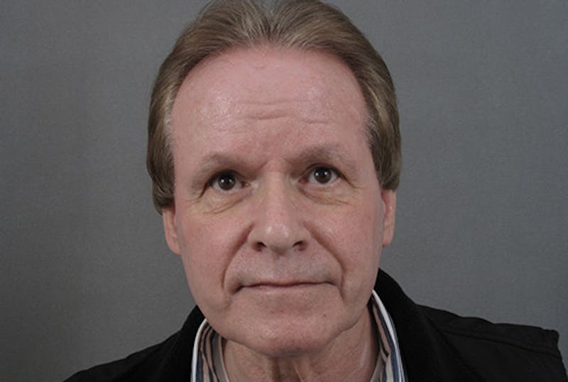 Neck Lift Before & After Gallery - Patient 363754 - Image 3