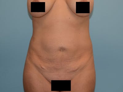 Tummy Tuck Before & After Gallery - Patient 120905377 - Image 1