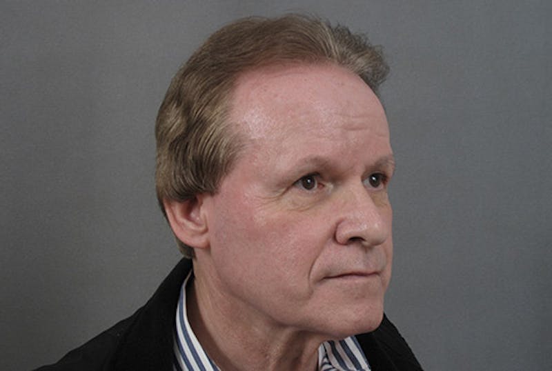 Neck Lift Before & After Gallery - Patient 363754 - Image 5