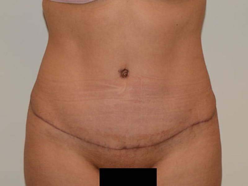 Tummy Tuck Before & After Gallery - Patient 120905382 - Image 2