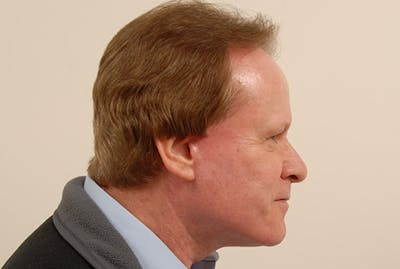 Neck Lift Before & After Gallery - Patient 363754 - Image 2