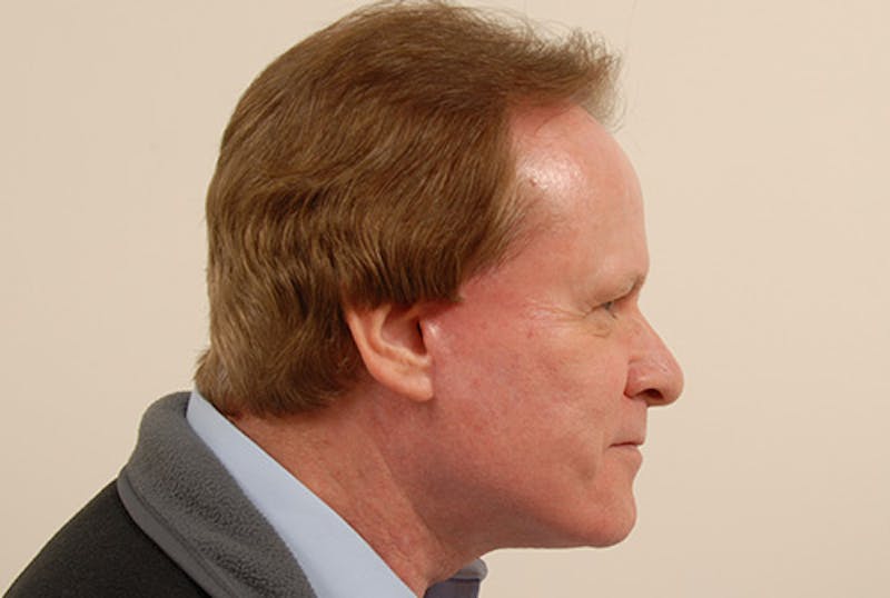 Neck Lift Before & After Gallery - Patient 363754 - Image 2