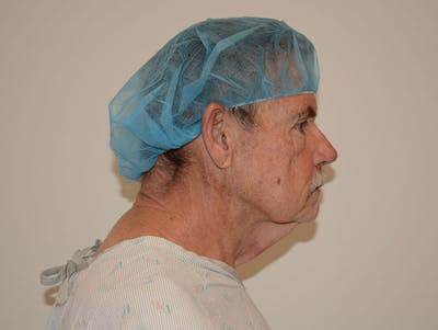 Facelift Before & After Gallery - Patient 120905383 - Image 1
