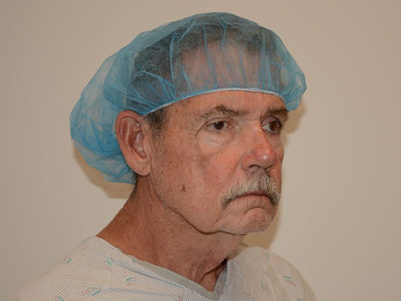 Facelift Before & After Gallery - Patient 120905383 - Image 3