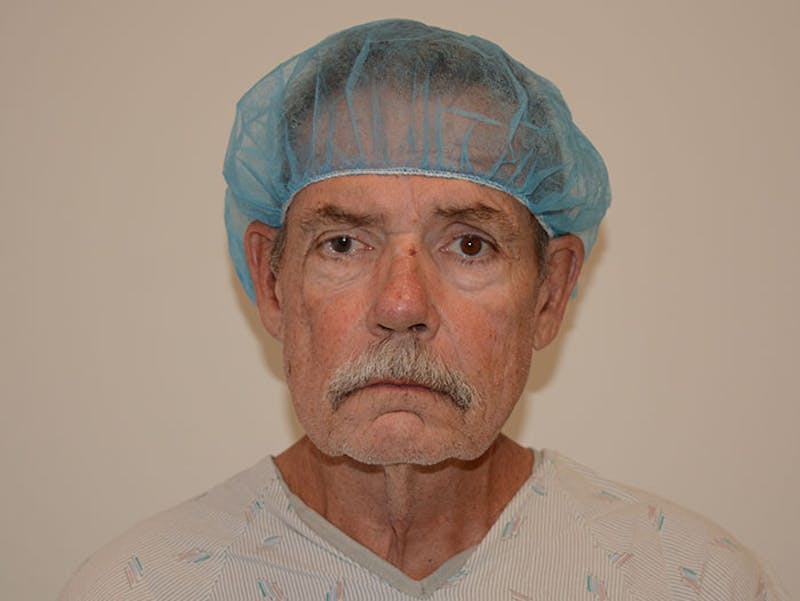 Facelift Before & After Gallery - Patient 120905383 - Image 5