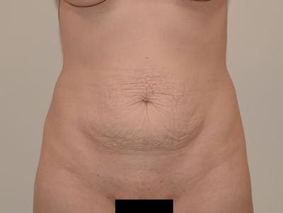 Tummy Tuck Before & After Gallery - Patient 120905384 - Image 1