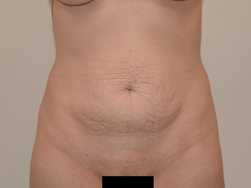 Tummy Tuck Before & After Gallery - Patient 120905384 - Image 1
