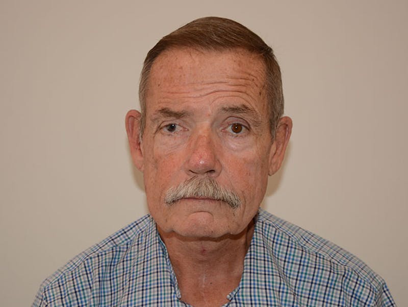 Facelift Before & After Gallery - Patient 120905383 - Image 6