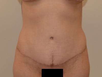 Tummy Tuck Before & After Gallery - Patient 120905384 - Image 2