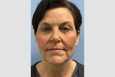 Facelift Before & After Gallery - Patient 120905386 - Image 1