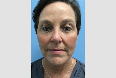 Facelift Before & After Gallery - Patient 120905386 - Image 2