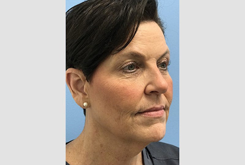 Facelift Before & After Gallery - Patient 120905386 - Image 3