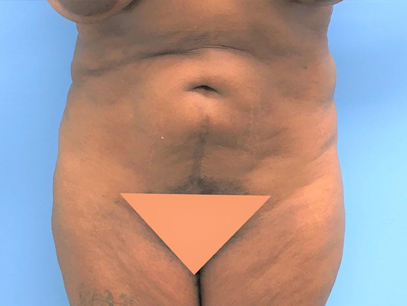 Tummy Tuck Before & After Gallery - Patient 120905387 - Image 1