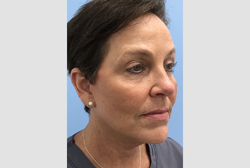 Facelift Before & After Gallery - Patient 120905386 - Image 4