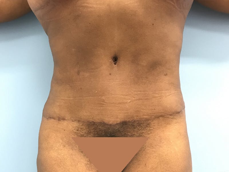 Tummy Tuck Before & After Gallery - Patient 120905387 - Image 2