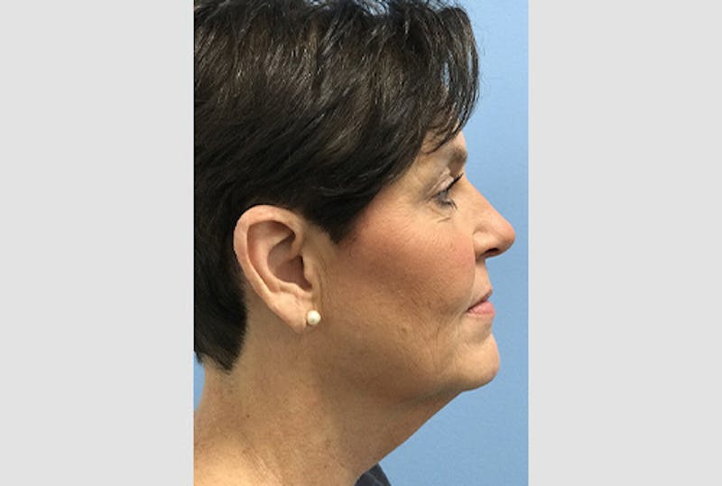 Facelift Before & After Gallery - Patient 120905386 - Image 5