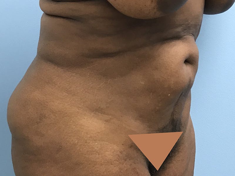 Tummy Tuck Before & After Gallery - Patient 120905387 - Image 3