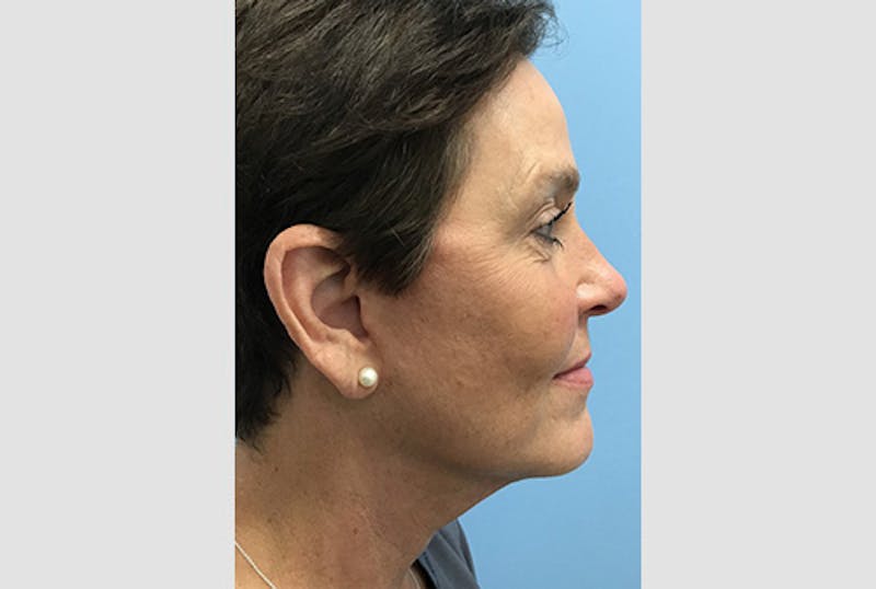 Facelift Before & After Gallery - Patient 120905386 - Image 6