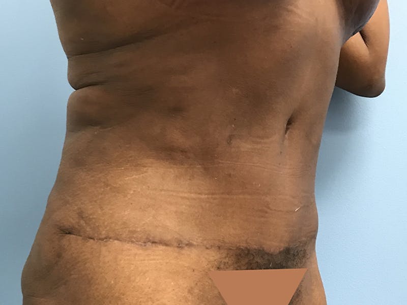 Tummy Tuck Before & After Gallery - Patient 120905387 - Image 4