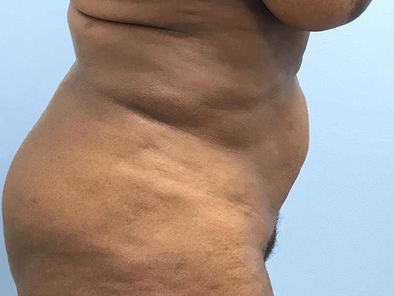 Tummy Tuck Before & After Gallery - Patient 120905387 - Image 5