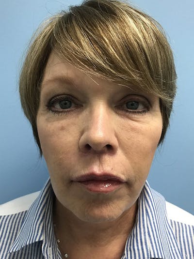 Facelift Before & After Gallery - Patient 120905390 - Image 2