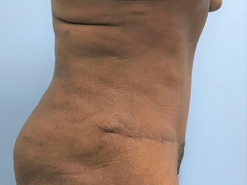 Tummy Tuck Before & After Gallery - Patient 120905387 - Image 6