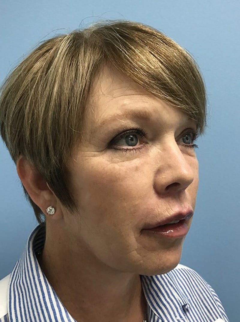 Facelift Before & After Gallery - Patient 120905390 - Image 4