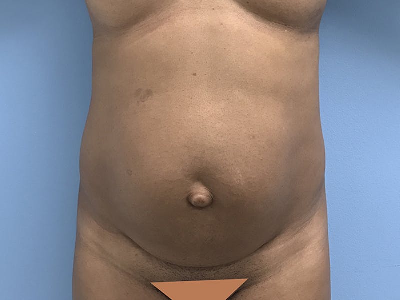 Tummy Tuck Before & After Gallery - Patient 120905402 - Image 1