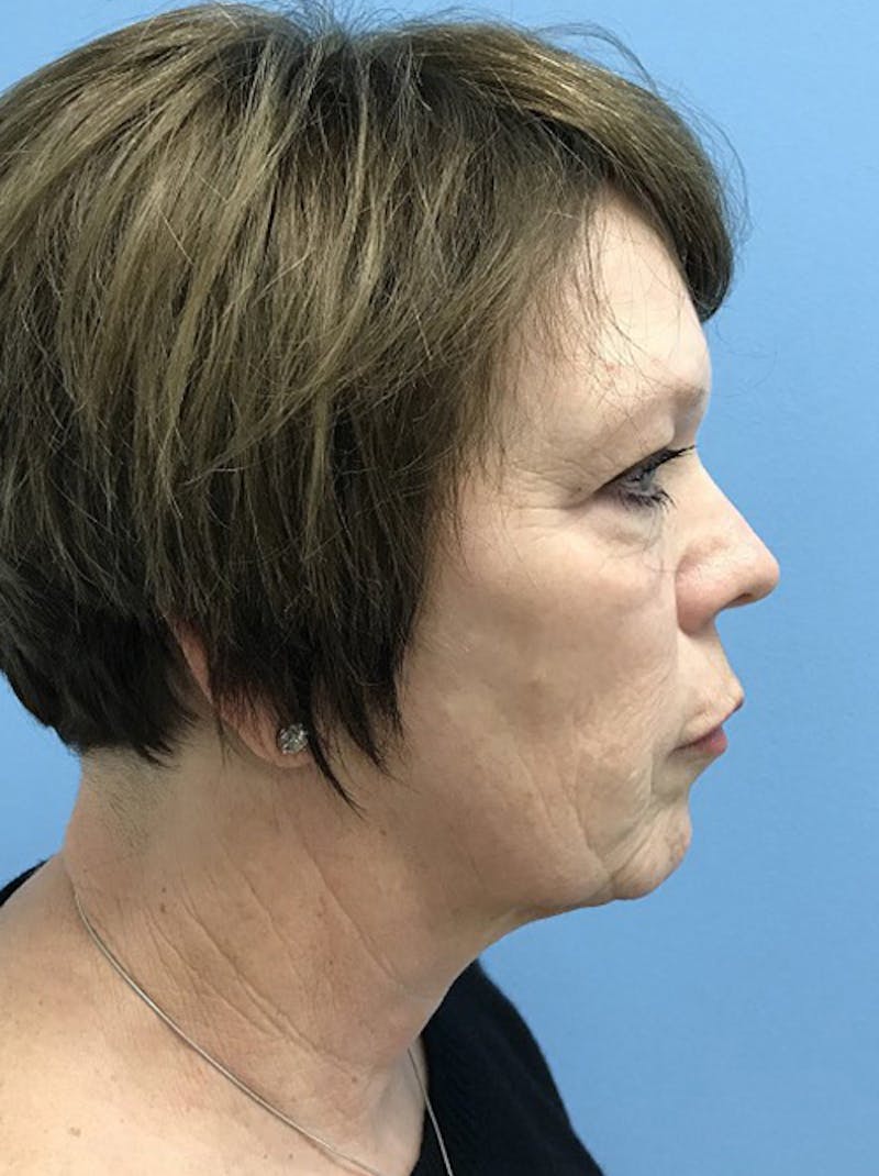 Facelift Before & After Gallery - Patient 120905390 - Image 5