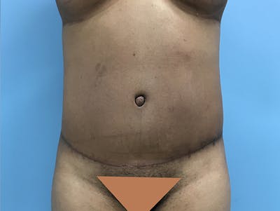 Tummy Tuck Gallery - Patient 120905402 - Image 2