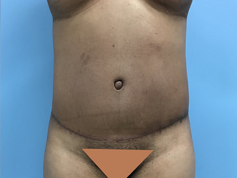 Tummy Tuck Before & After Gallery - Patient 120905402 - Image 2