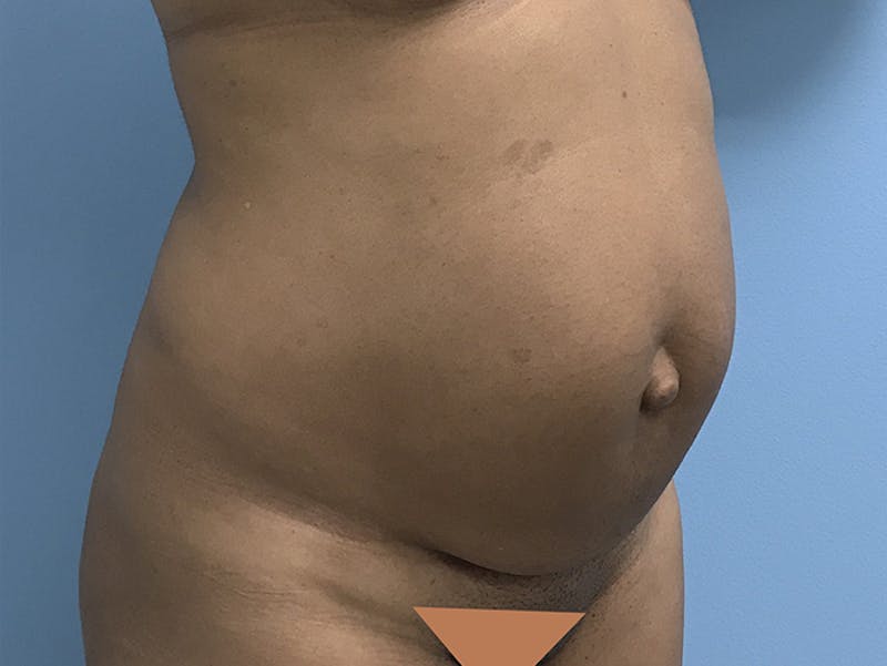 Tummy Tuck Before & After Gallery - Patient 120905402 - Image 3