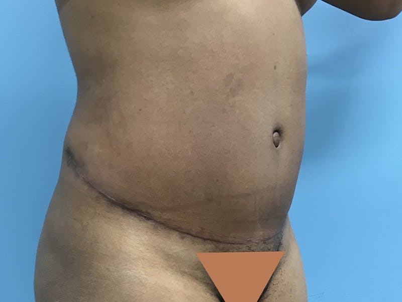 Tummy Tuck Before & After Gallery - Patient 120905402 - Image 4