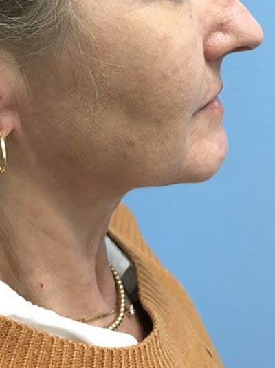 Facelift Before & After Gallery - Patient 120905405 - Image 1