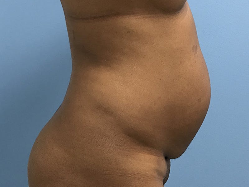 Tummy Tuck Before & After Gallery - Patient 120905402 - Image 5
