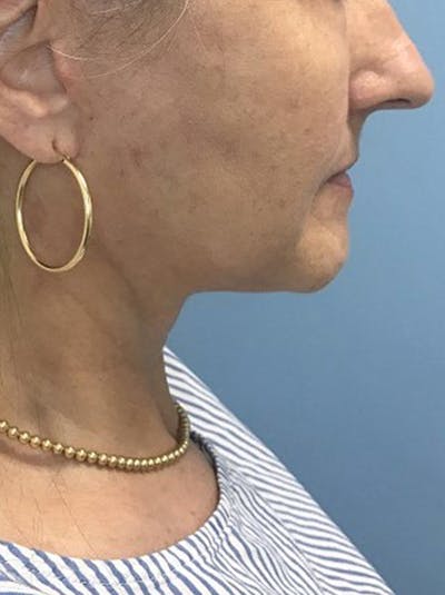 Facelift Before & After Gallery - Patient 120905405 - Image 2